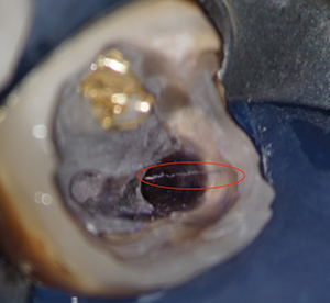 破折の確認